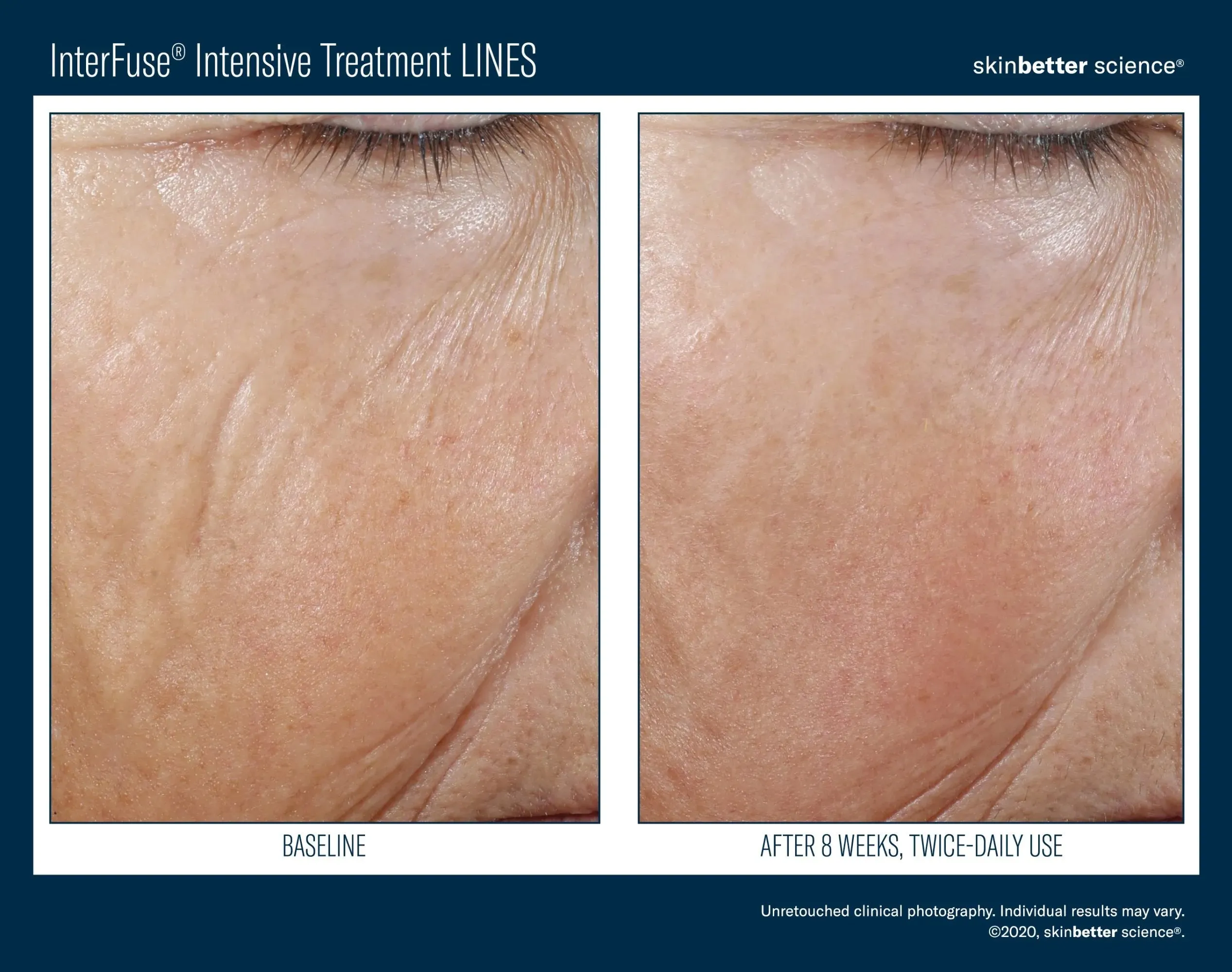 SKINBETTER InterFuse Intensive Treatment LINES